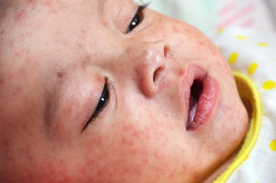 Measles Mass Campaign: Frequently Asked Questions